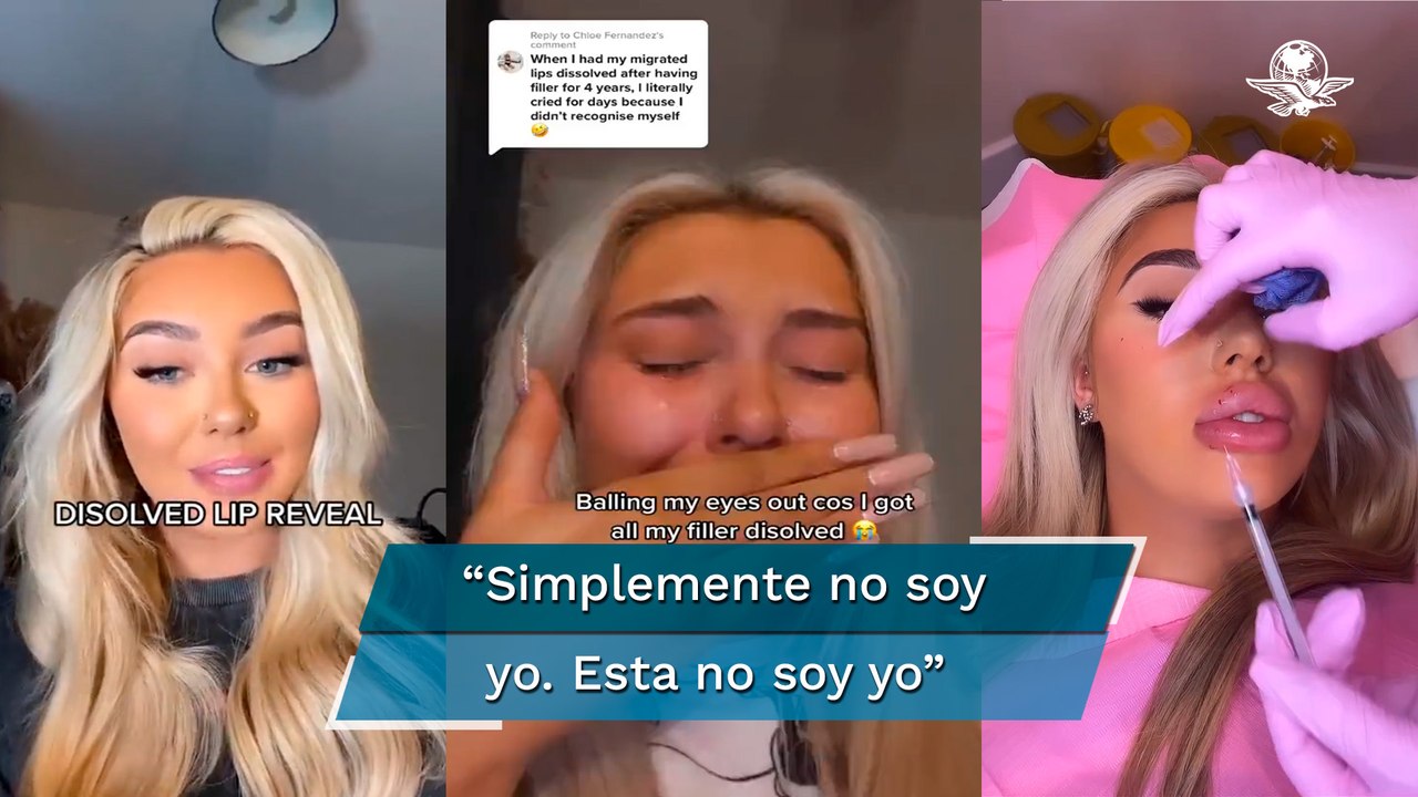 Tiktoker se hace cirugía para reducirse los labios y el resultado la aterra 