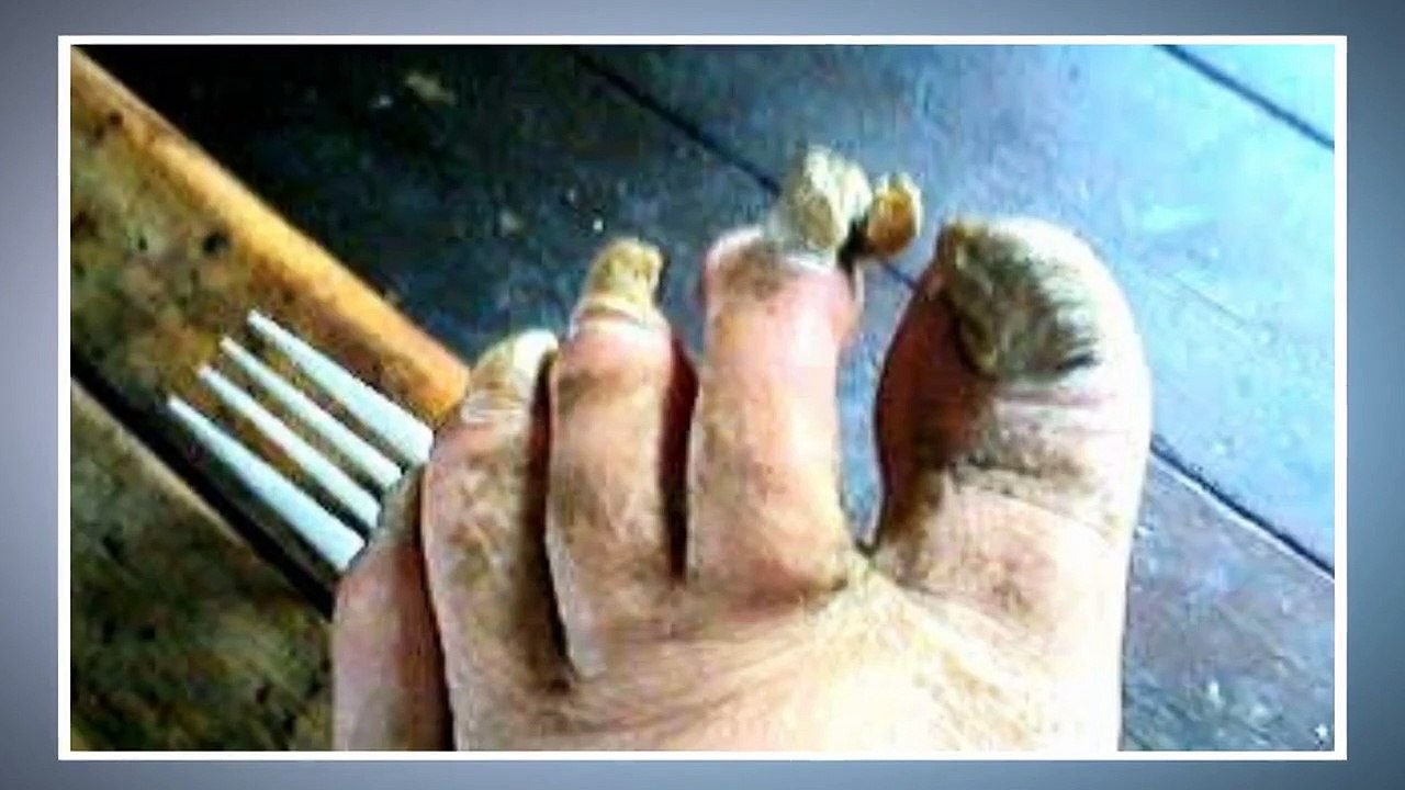 My Feet Are Killing Me - First Steps - Se1 - Ep07 - The Fungus Among Us HD Watch