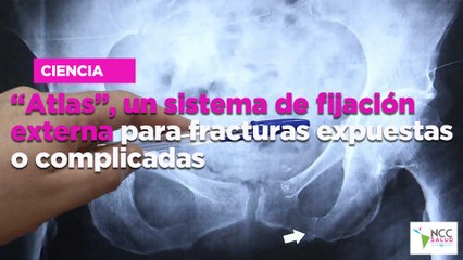 “Atlas”, un sistema de fijación externa para fracturas expuestas o complicadas