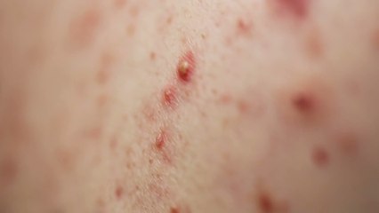 Chicken pox: You can get the contagious infection more than once, here’s how