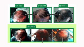 Hair Regrowth through Follicular Activation - No Harmful Pharmaceutical