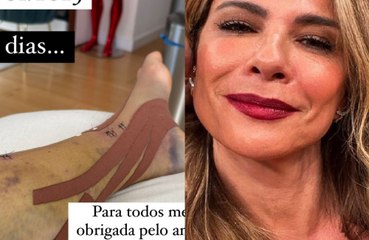 Luciana Gimenez compartilha foto da perna após acidente: ‘Tem sido muito dolorido’