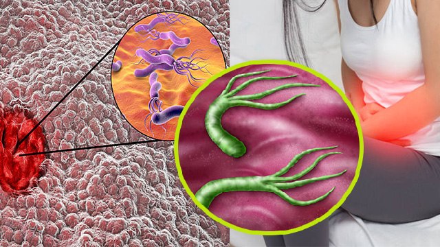 पेट में छाले क्यों होते है, पेट में छाले होना क्या बीमारी है, पेट छाले होने का कारण |Boldsky*Health