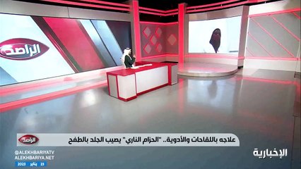 بالفيديو.. استشارية: المصابون بالحزام الناري قد تتضرر أعينهم