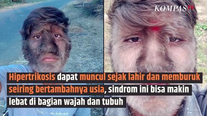 Mengenal Sindrom Manusia Serigala| SINAU