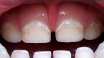 bd-manchas-en-los-dientes-señales-de-caries-250123
