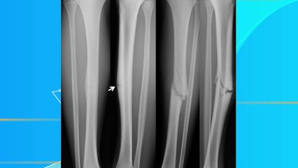 bd-fracturas-causadas-por-repeticion-de-algunos-movimientos-270123