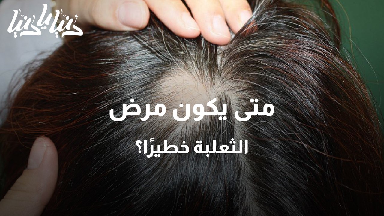 مرض الثعلبة .. أسبابه والعلاجات المتاحة