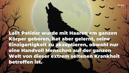 Teenager in Indien leidet am Werwolf-Syndrom