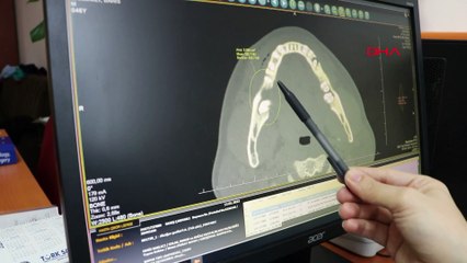 Çenesinden tümör alındı: Bacağından kemik konuldu