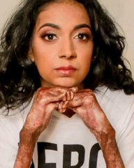 Growing up with 'butterfly skin'