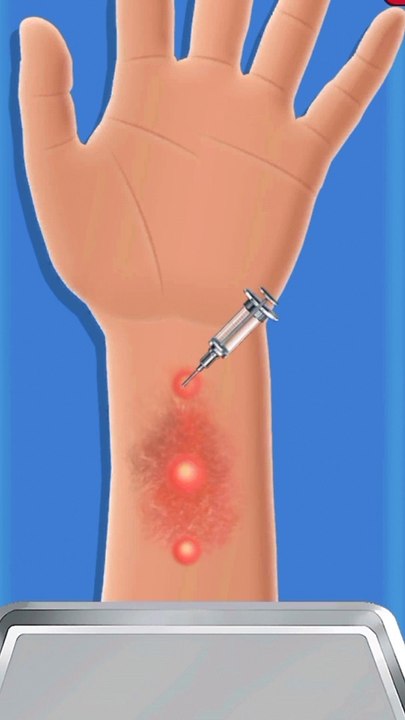 ASMR Treatment of infections caused by wearing facial piercings - 얼굴 피어싱 착용으로 인한 감염 치료