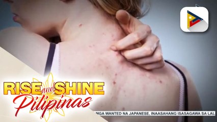 Mga dapat tandaan kapag may backne o acne sa likod