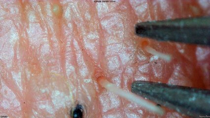 0329 pull out hair around the chin 毛抜き 顎 周辺