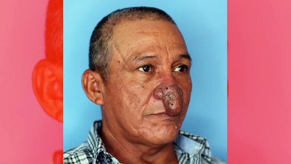 Homem com 'nariz peculiar' tem vida transformada após encontro casual no trabalho