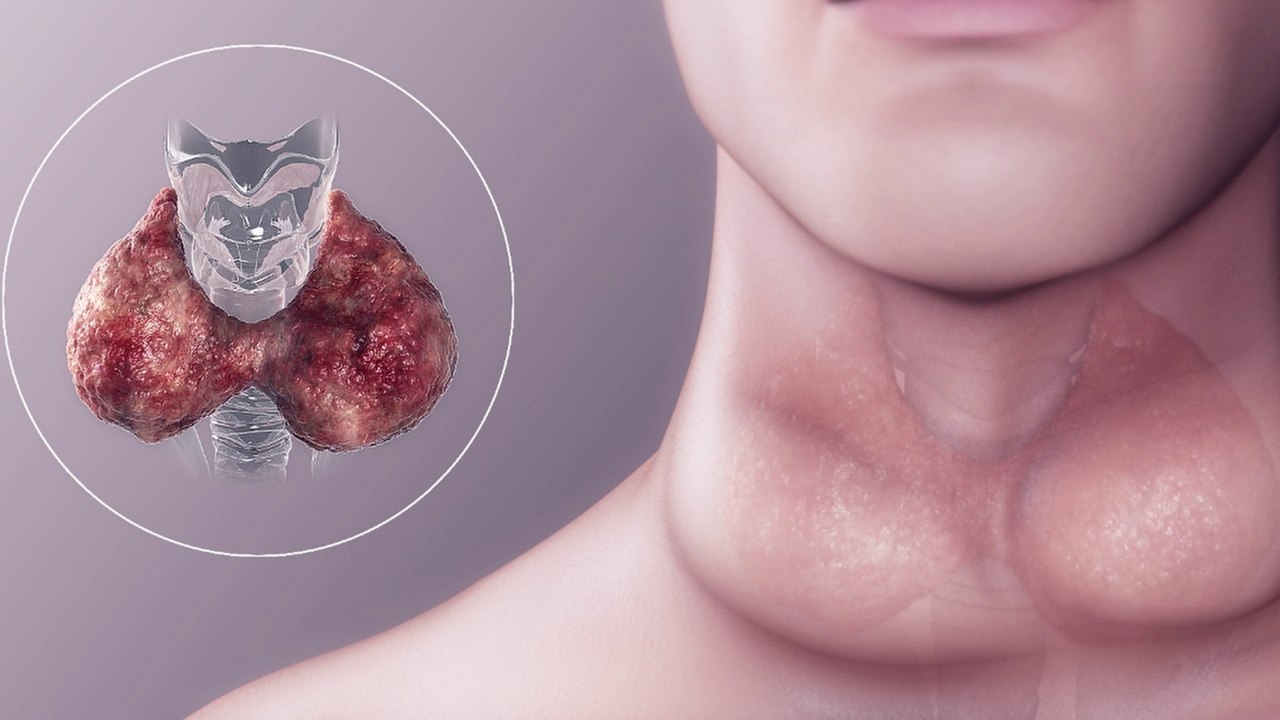 bd-historia-familiar-influye-en-casos-de-tiroides-090223