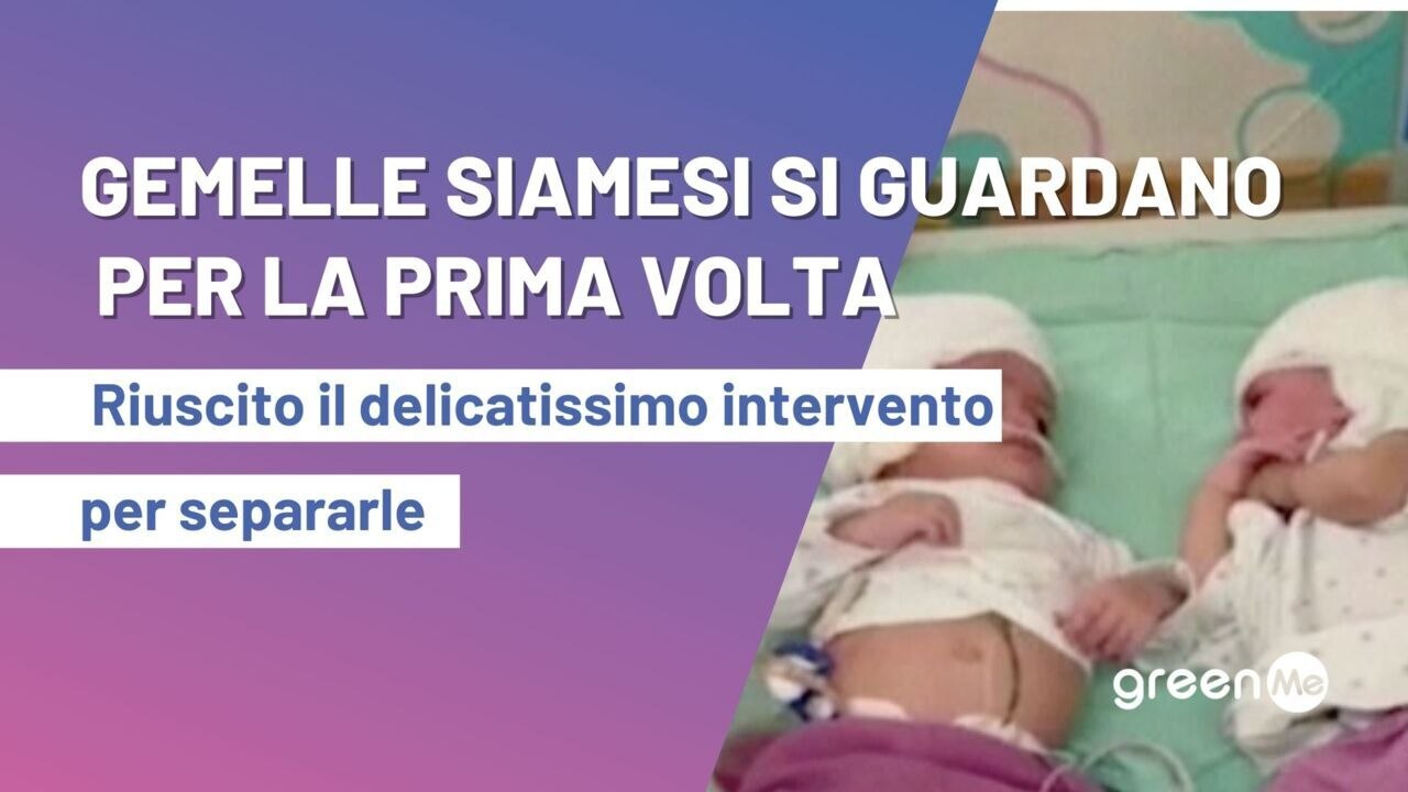 Gemelle siamesi riescono a guardarsi per la prima volta , riuscito il delicatissimo intervento per separarle