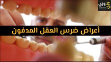 أهم أعراض ضرس العقل المدفون