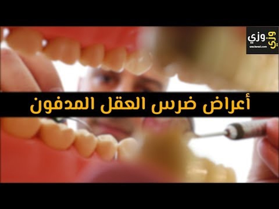 أهم أعراض ضرس العقل المدفون