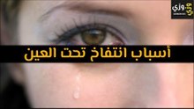 أهم أسباب انتفاخ تحت العين