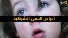 أهم أعراض الحمى الشوكية