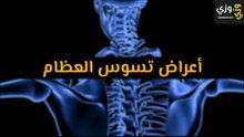 أهم أعراض تسوس العظام