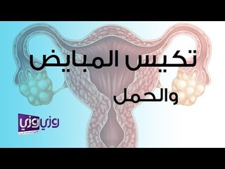 تكيس المبايض والحمل