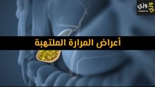 أهم أعراض المرارة الملتهبة