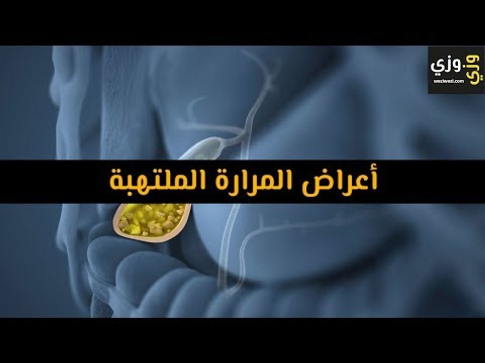 أهم أعراض المرارة الملتهبة