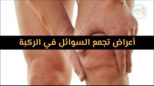 أهم أعراض تجمع السوائل في الركبة