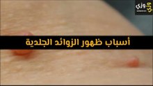 أهم أسباب ظهور الزوائد الجلدية