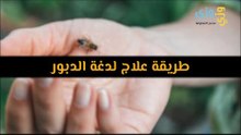 أهم طريقة علاج لدغة الدبور