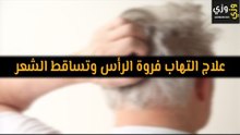 أهم علاج التهاب فروة الرأس وتساقط الشعر