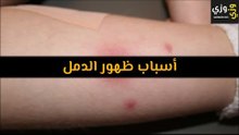 أهم أسباب ظهور الدمل