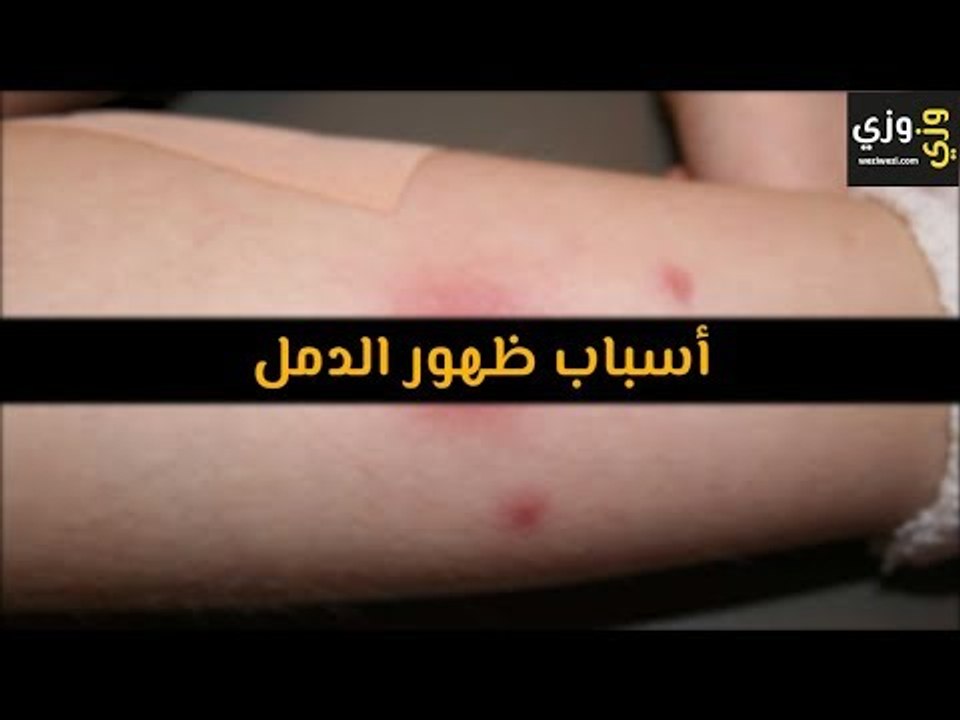 أهم أسباب ظهور الدمل