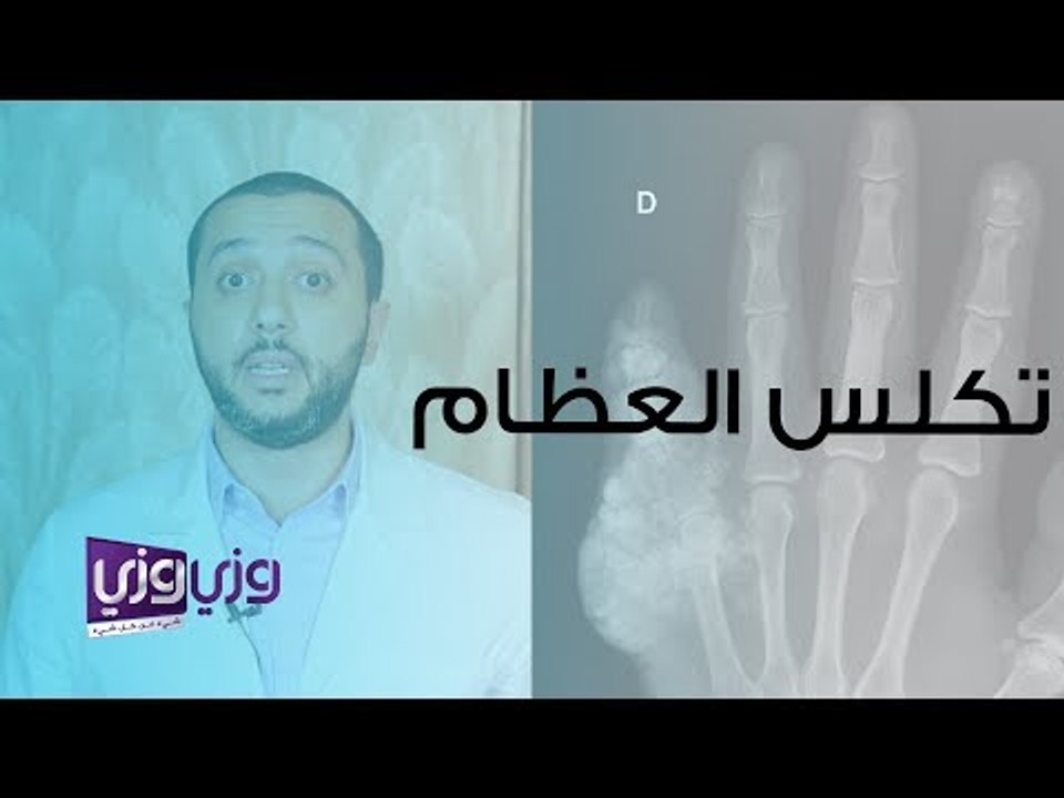 ما هو تكلس العظم وما هي أسبابه وعلاجه