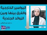 البواسير الخارجية والفرق بينها وبين الزوائد الجلدية