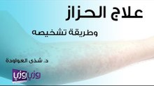 علاج الحزاز وطريقة تشخيصه