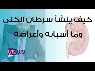 كيف ينشأ سرطان الكلى وما أسبابه وأعراضه