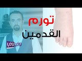 علاج تورم القدمين