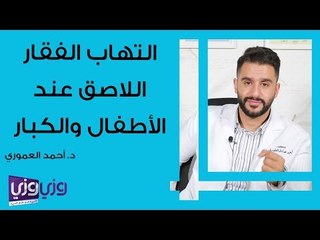 التهاب الفقار اللاصق عند الأطفال والكبار
