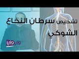 تشخيص سرطان النخاع الشوكي وطريقة علاجه