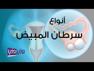 أنواع سرطان المبيض: دليل شامل لعلاماته وأسبابه 🩺