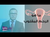 ما هو الرحم المقلوب وهل يحتاج إلى علاج؟