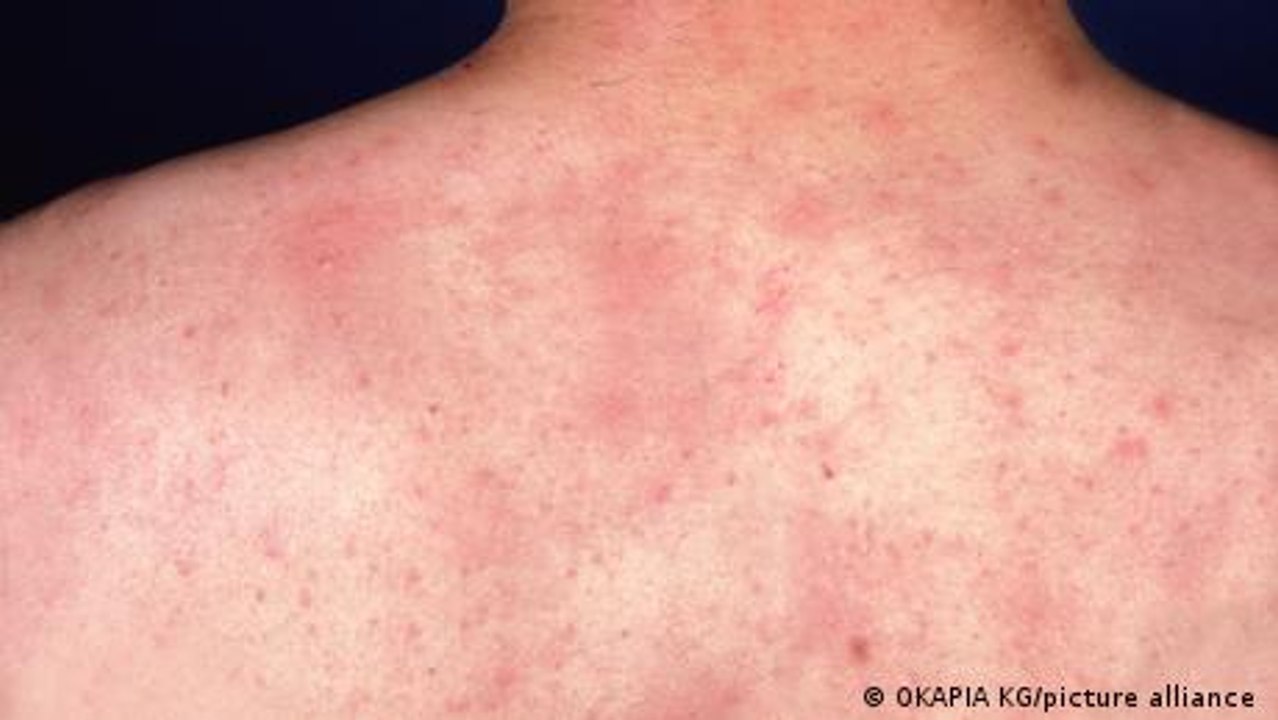 Ein Irrtum des Immunsystems