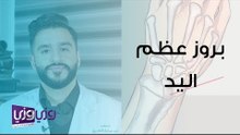 بروز عظم في معصم اليد