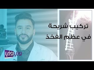 عملية تركيب شريحة في عظمة الفخذ
