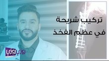 عملية تركيب شريحة في عظمة الفخذ