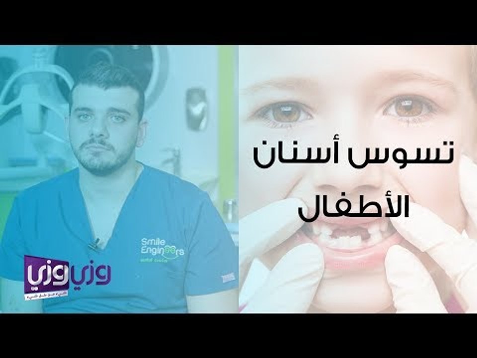 تسوس أسنان الأطفال