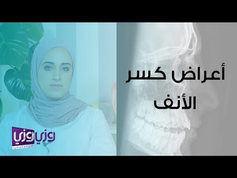 أعراض كسر الأنف وتشخيصه